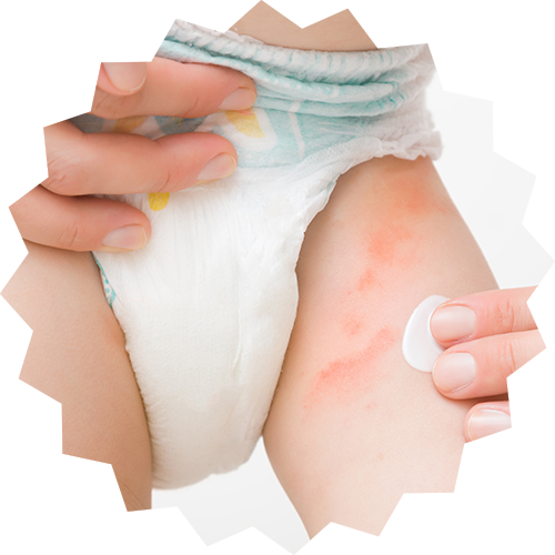 Baby Diaper Rash