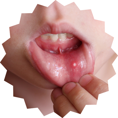Canker Sores