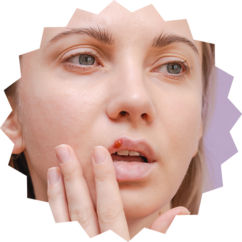 Cold Sores