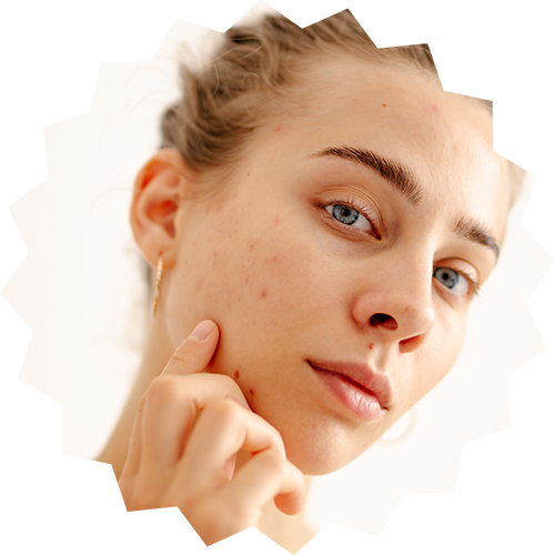 Mild Acne