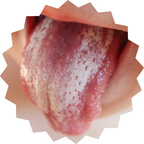 Oral Thrush
