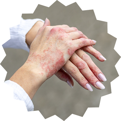 Skin Eczema